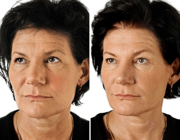 O resultado do rexuvenecemento fraccionado da cara