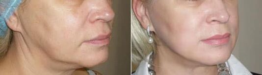 Foto despois de aplicar o procedemento