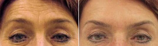 Rexuvenecemento do campo da testa