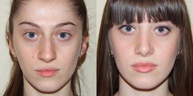 antes e despois do rexuvenecemento da pel con plasma